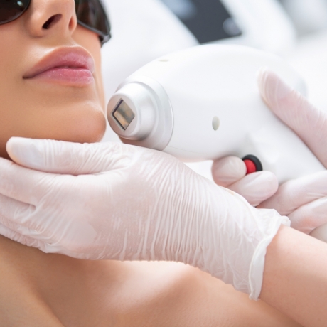 Epilazione Laser Mento